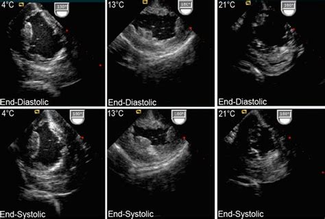 normal 2d echo result|All You Need to Know: How to Read the 2D Echo Test Result.